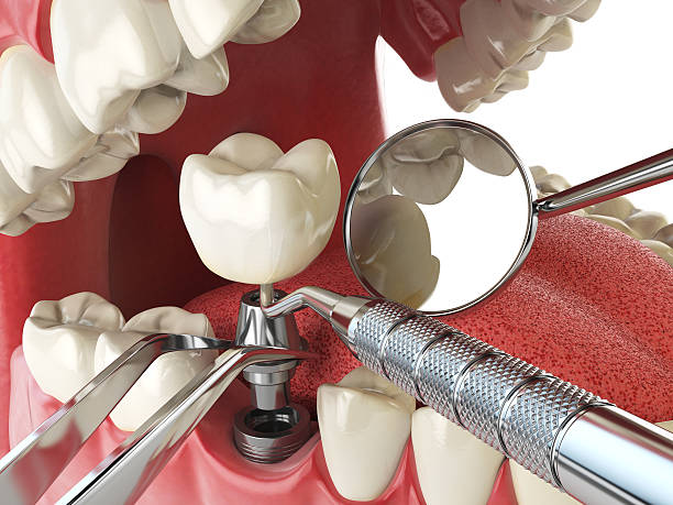 Best Broken or Chipped Tooth Repair in Santa Clara, NM
